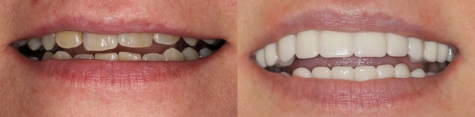 dental implants before and after all on 4